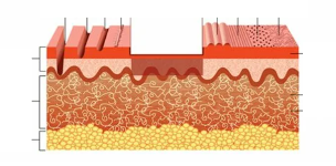 түрлері лазерлік пилинг